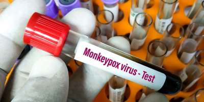 monkeypox Fifth case found in Delhi - Satya Hindi